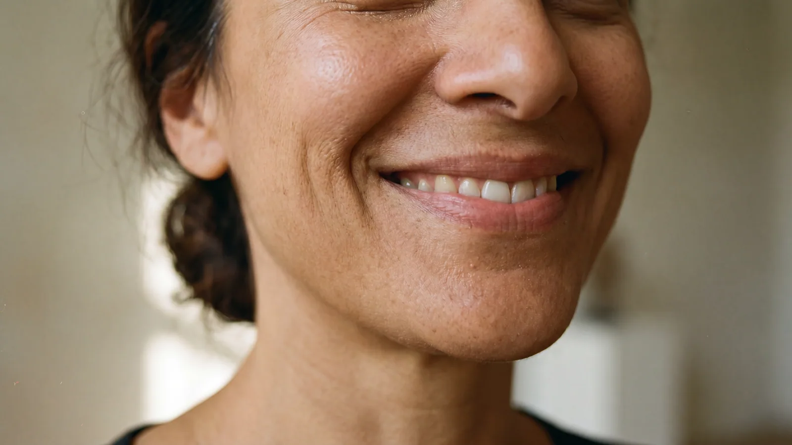 Smile Lines