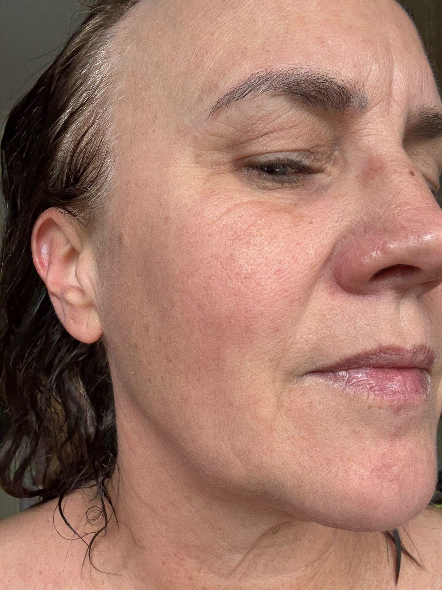 Before treatment