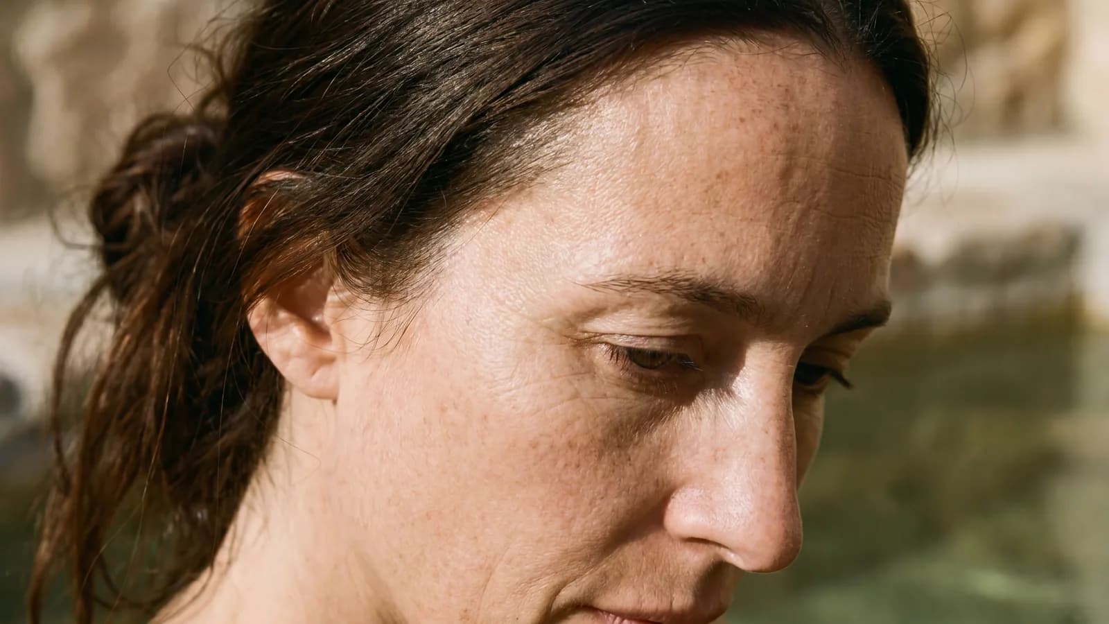 Fotona Acne & Scar Revision, aesthetic treatment at Baudelaire Aesthetics, Bath