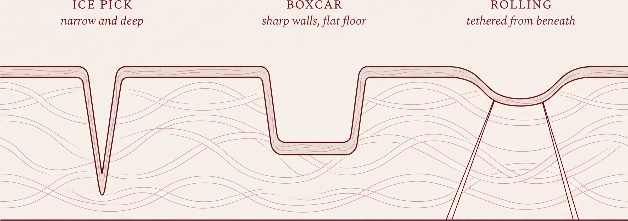 The three shapes of atrophic acne scarring. Ice pick is narrow and deep; boxcar has sharp vertical walls and a flat floor; rolling is broad and shallow, tethered from beneath by fibrous bands.
