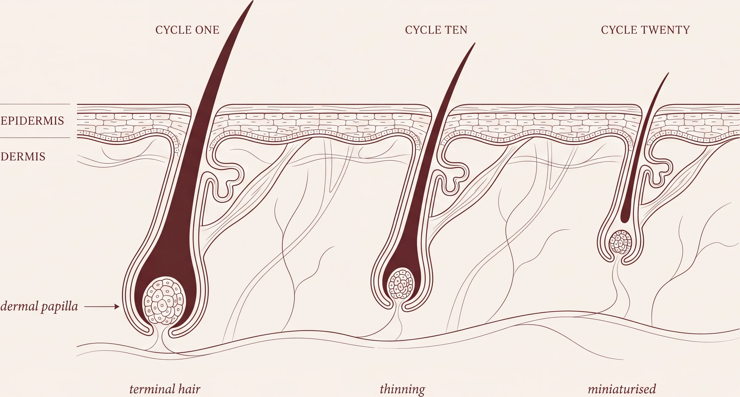 Successive growth cycles in androgenetic alopecia. The dermal papilla at the base of the follicle loses cells with each cycle, so the follicle builds a progressively smaller hair: terminal, then thinning, then miniaturised.