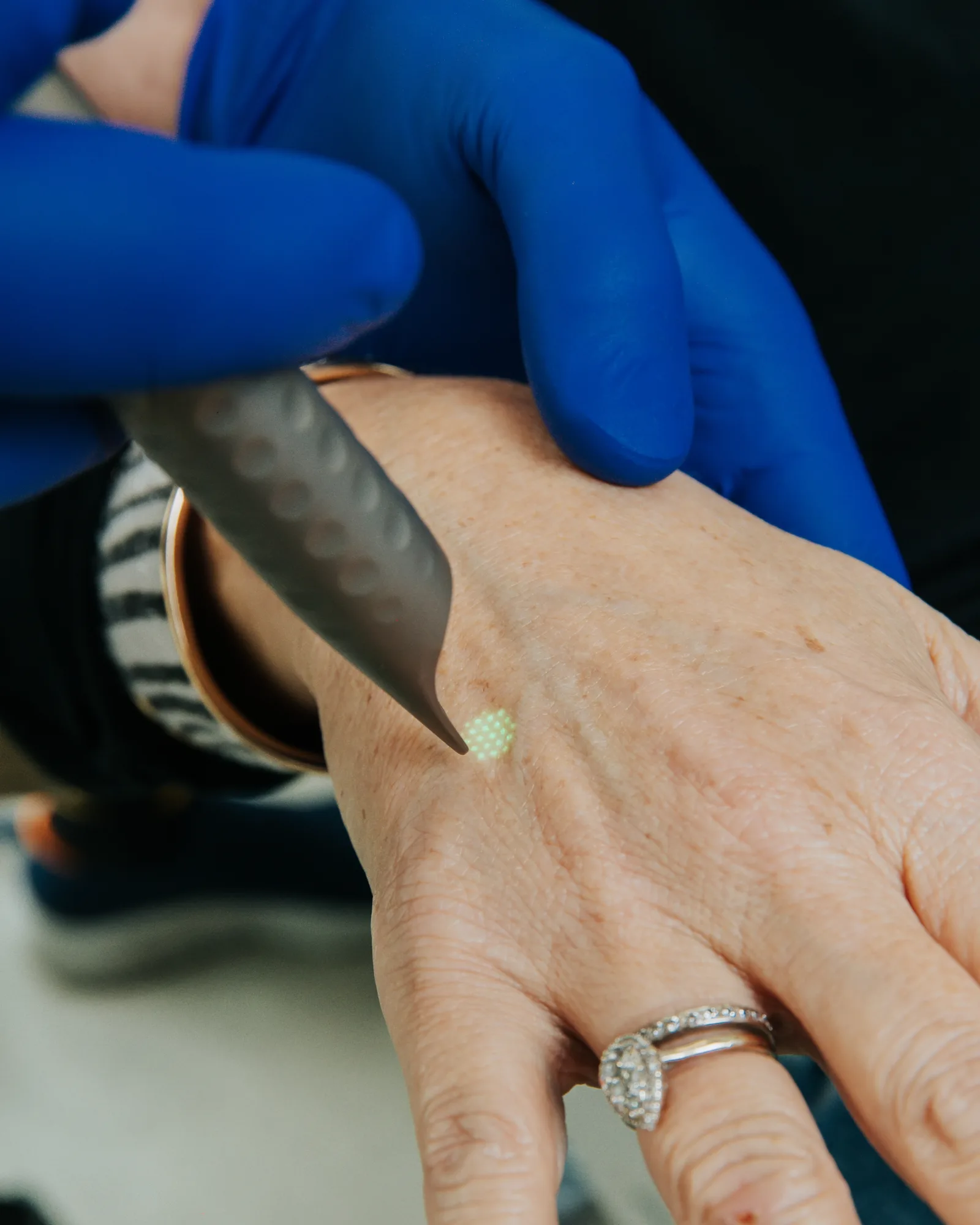 The same fractional pattern on the back of a hand, where sun damage shows earliest and is often left untreated. The scattered pigment here is the accumulated record of ultraviolet exposure.