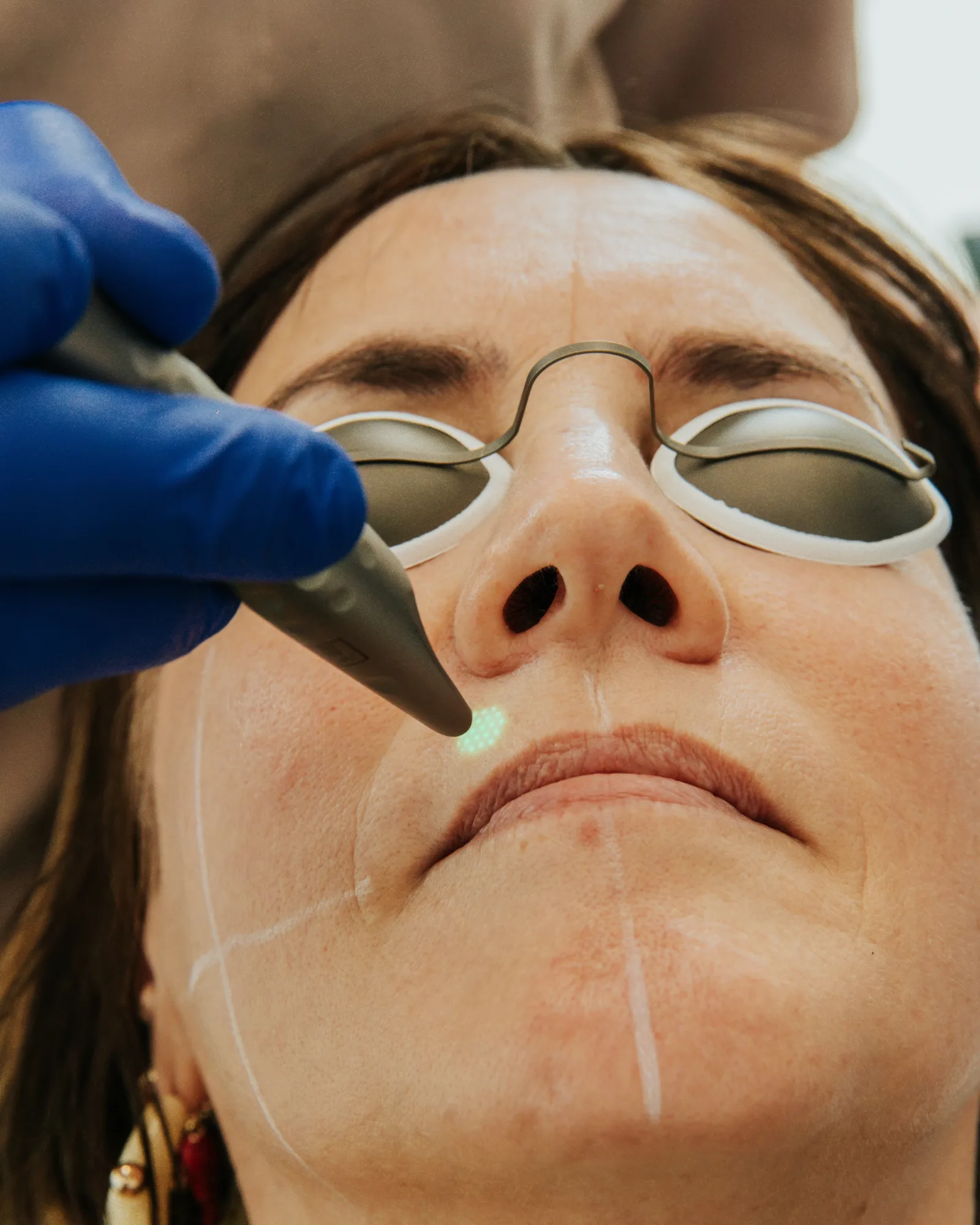 The fractional grid, visible as the handpiece is positioned over the perioral skin. Each dot marks one microscopic column of treated tissue, with untreated skin left between them to drive the healing.