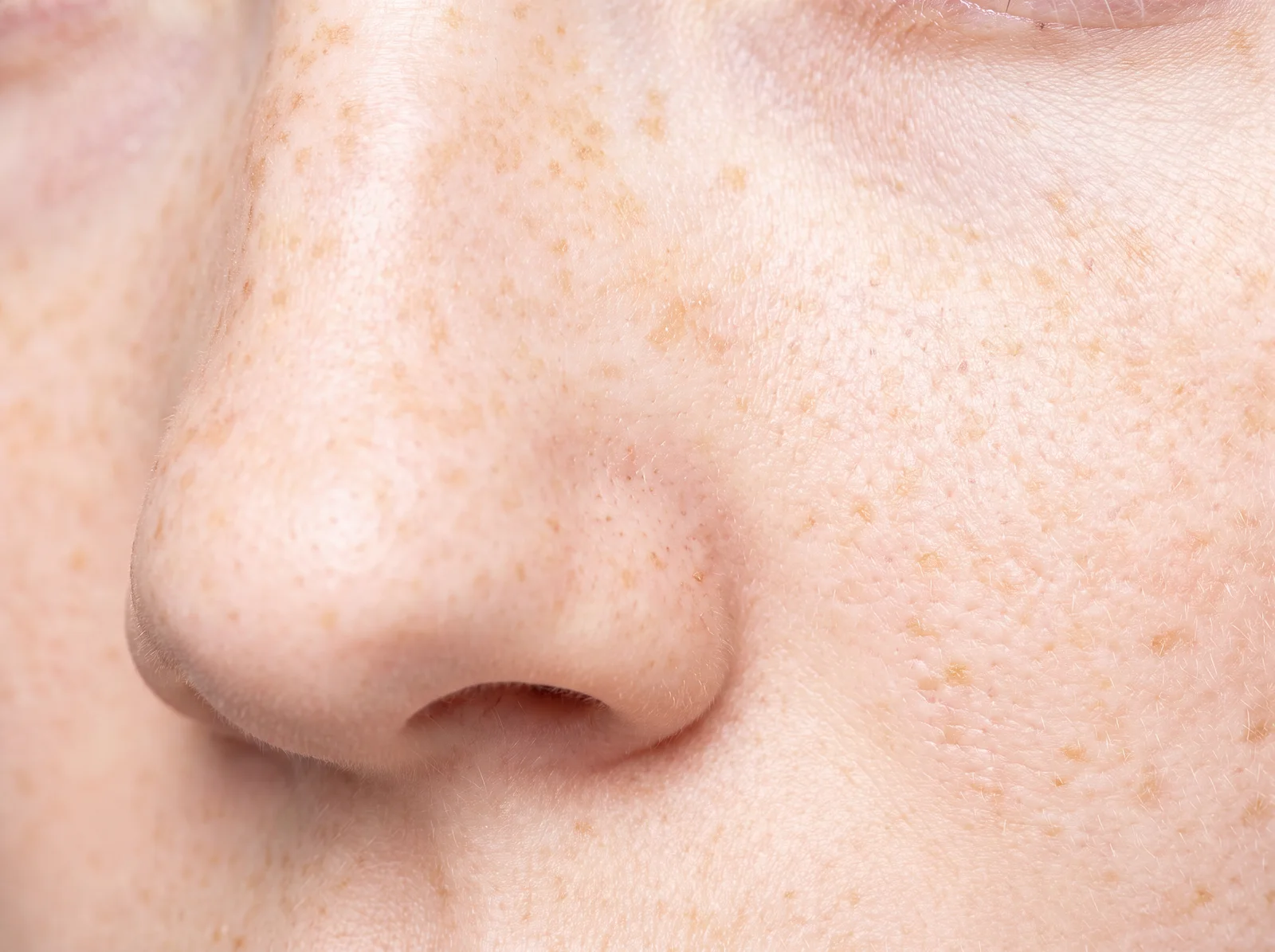 Freckles, or ephelides. Small, numerous, soft-edged and genetically determined, they darken with sun and fade in winter, and they are superficial in the same way sun spots are.