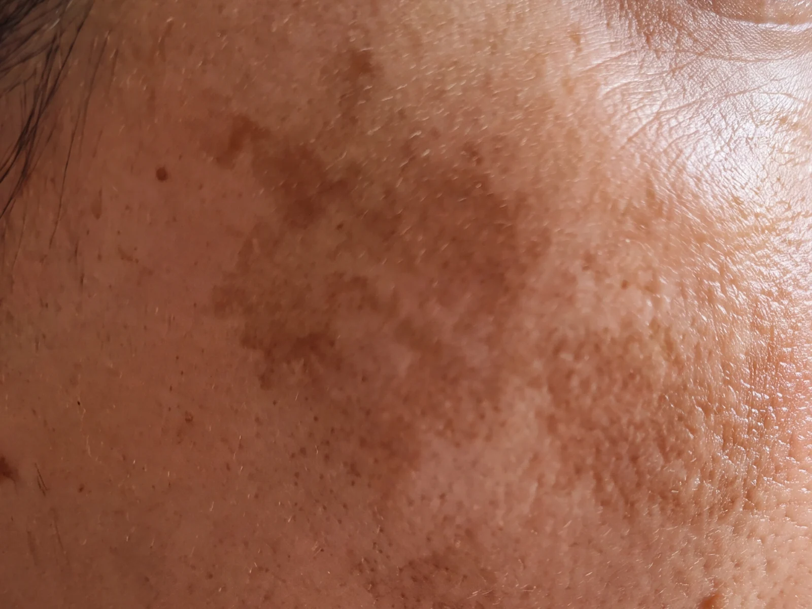 Melasma. Compare it with the sun spots above: rather than separate marks with edges, this is a broad blotchy veil that thins gradually into the surrounding skin with no border you could trace. That difference in appearance reflects a difference in depth and cause, and it is why the treatments diverge.