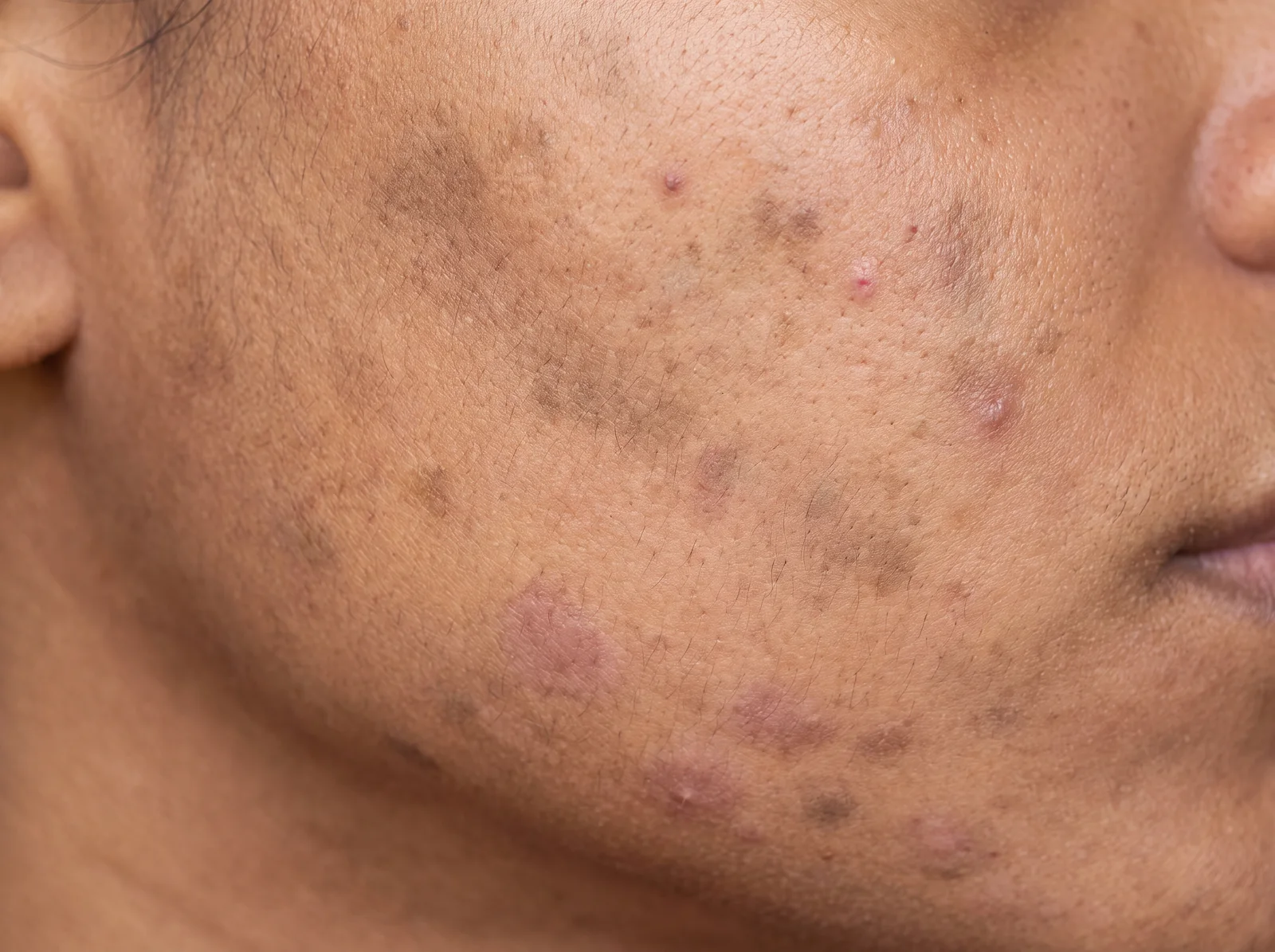 Post-inflammatory hyperpigmentation following acne. Note the character that identifies it: the marks are soft-edged smudges that fade into the surrounding skin rather than discrete bordered spots, they sit completely flat and level with the surface, and they vary in age from faded tan to the pink-mauve of recent ones. They cluster along the jawline, mapping where the breakouts were.