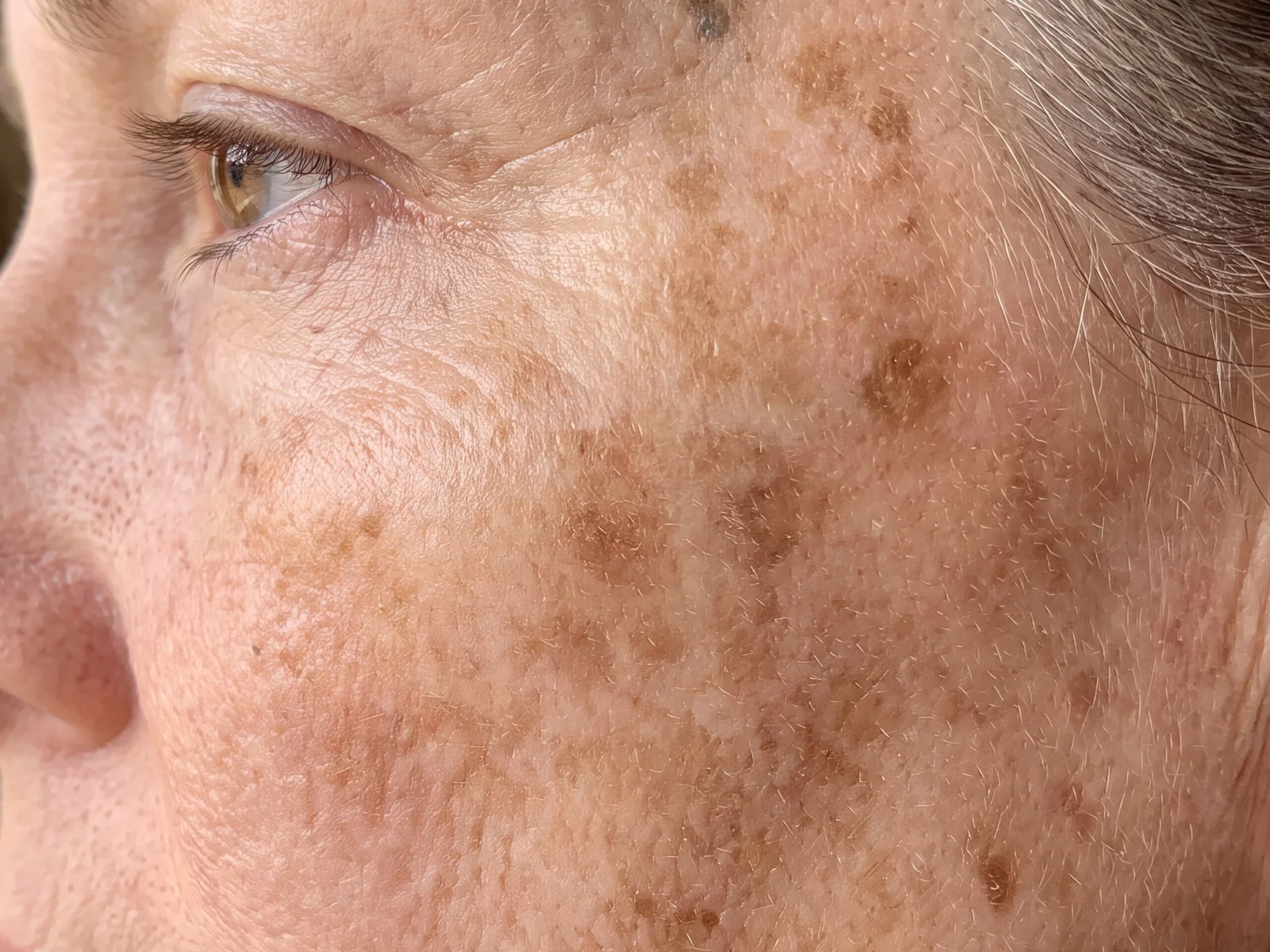 Solar lentigines, or sun spots. Note the character that decides the treatment: each mark is discrete and separate with its own edge, varying in size and depth of colour, on skin that also carries the general weathering of long sun exposure.