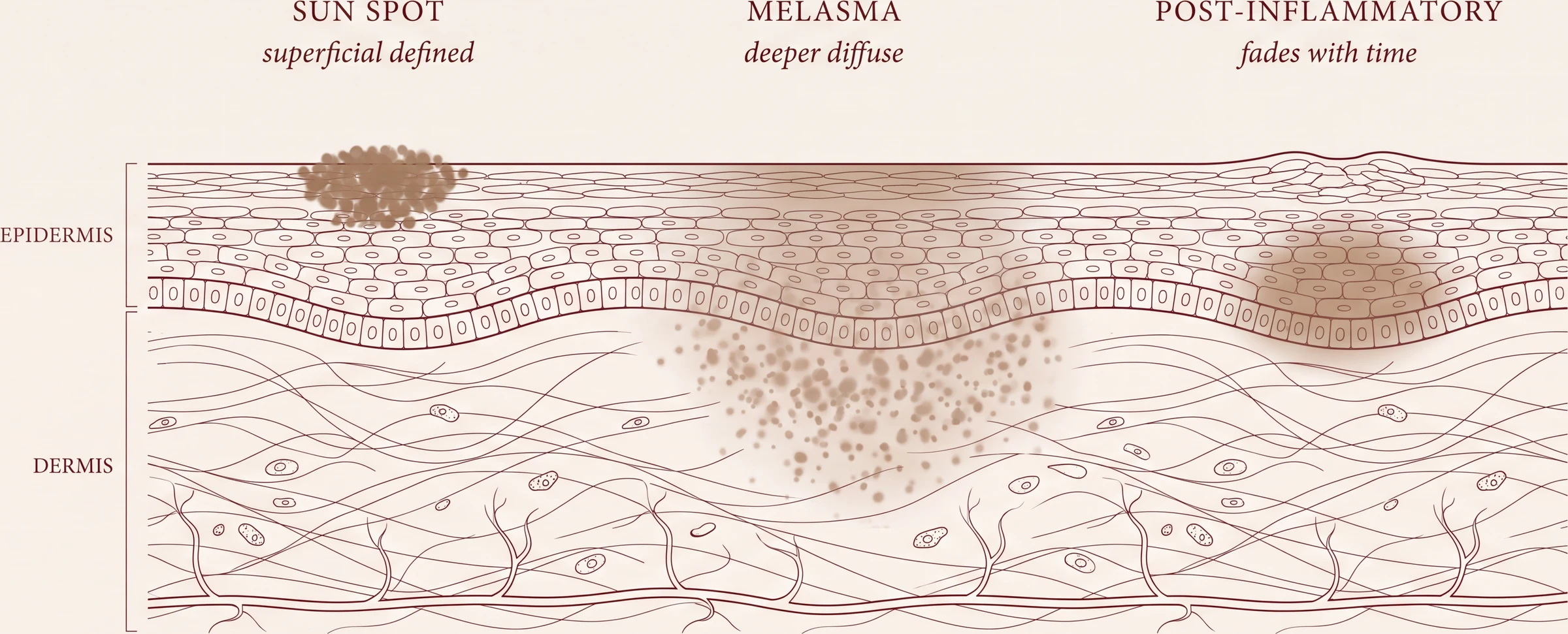 Pigment sorts by cause and depth. Sun spots and freckles are discrete and superficial, and respond well. Melasma is diffuse, deeper and hormonally driven, and is treated cautiously. Post-inflammatory marks follow injury and fade with time.