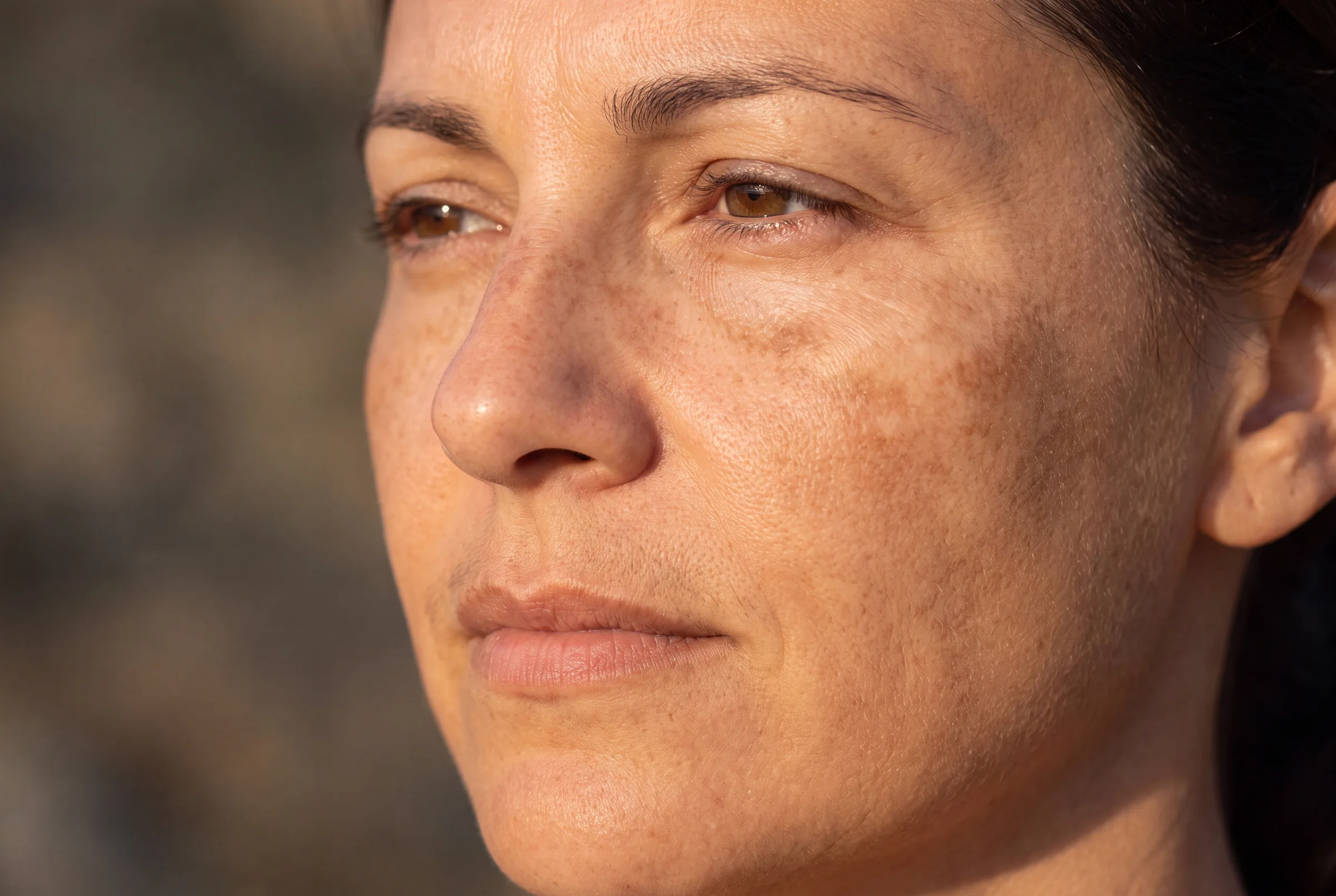 Pigmentation, Sun Spots and Melasma: Which Kind You Have, and Which Respond to Laser