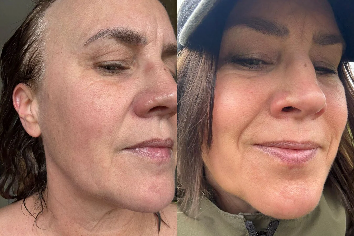 A real result from a course of microneedling with PRP, before on the left and after ten weeks on the right. It is typical for the protocol rather than a best case, and is published with the patient's written consent. No before and after is a promise about your own skin.
